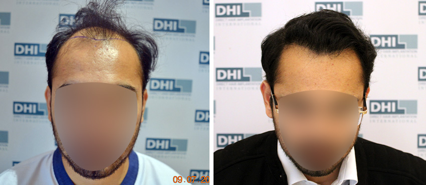 DHI before & after hair transplant results